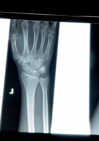 wrist fractures